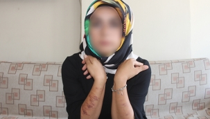 Lazer genç kadının vücudunu yaktı 