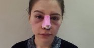 Çaldığı paralarla burnuna estetik yaptırdı
