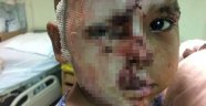 İki yaşındaki çocuğun yüzünü asitle yaktı