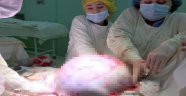 Rusya'da kadının yumurtalıklarından 25 kilogram tümör çıkarıldı