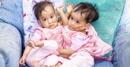 Yapışık ikizler Avustralya'da ameliyat edilecek